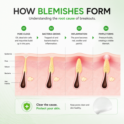 LUHAKA® Invisible Blemish Patch - Thin Hydrocolloid Acne Patches