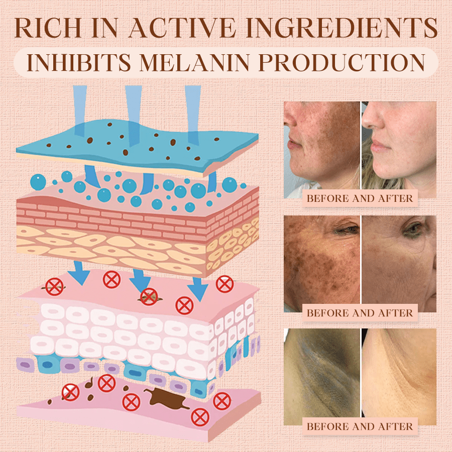 Luhaka® Purifying Exfoliating Gel ACE 1 for Acanthosis Nigricans, Exfoliation, Dark Spots, Skin Tags, and Eczema