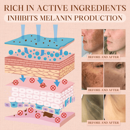 Luhaka® Purifying Exfoliating Gel ACE 1 for Acanthosis Nigricans, Exfoliation, Dark Spots, Skin Tags, and Eczema