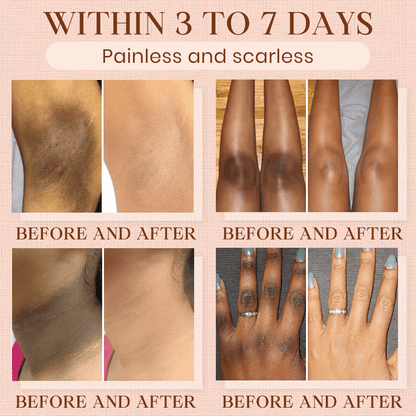 Luhaka® Purifying Exfoliating Gel ACE 1 for Acanthosis Nigricans, Exfoliation, Dark Spots, Skin Tags, and Eczema