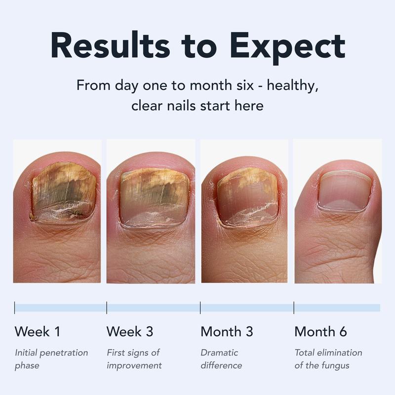 LUHAKA® Toenail Fungus Pen - UNDECYLENIC ACID 25% - Daily Solution for Brittle & Thickened Nails