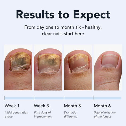LUHAKA® Toenail Fungus Pen - UNDECYLENIC ACID 25% - Daily Solution for Brittle & Thickened Nails