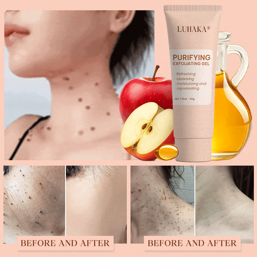 Luhaka® Purifying Exfoliating Gel ACE 1 for Acanthosis Nigricans, Exfoliation, Dark Spots, Skin Tags, and Eczema