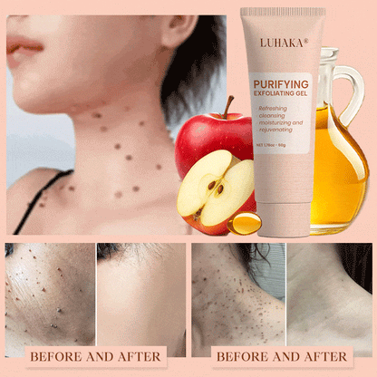 Luhaka® Purifying Exfoliating Gel ACE 1 for Acanthosis Nigricans, Exfoliation, Dark Spots, Skin Tags, and Eczema