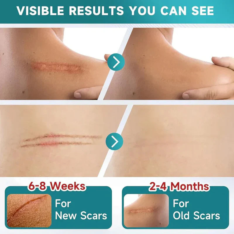 LUHAKA® Silicone Scar Remover Tape for Acne & Wrinkles