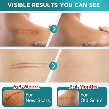 LUHAKA® Silicone Scar Remover Tape for Acne & Wrinkles