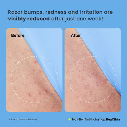 Luhaka® Niacelix Smoothing Solution Ingrown Hair Treatment